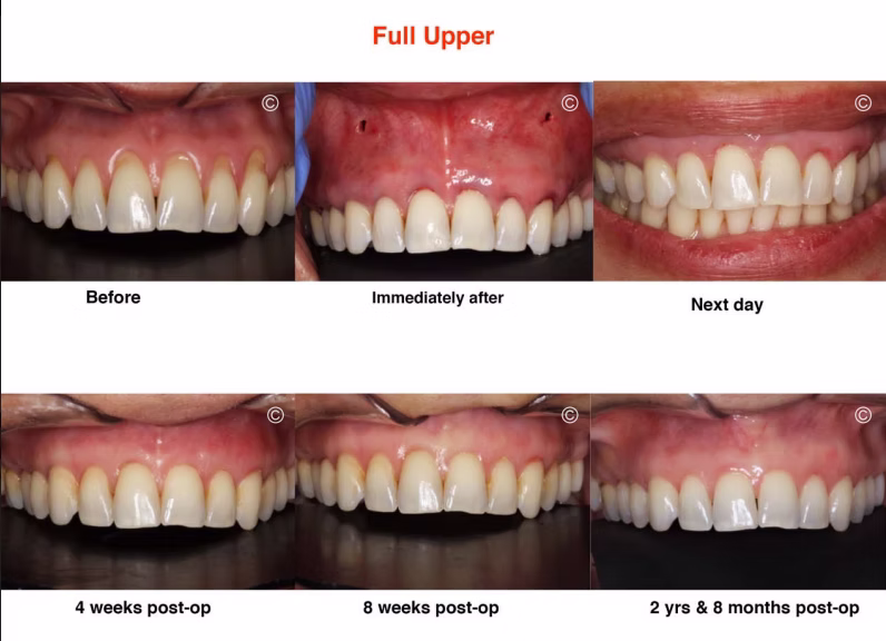 Pinhole procedure results